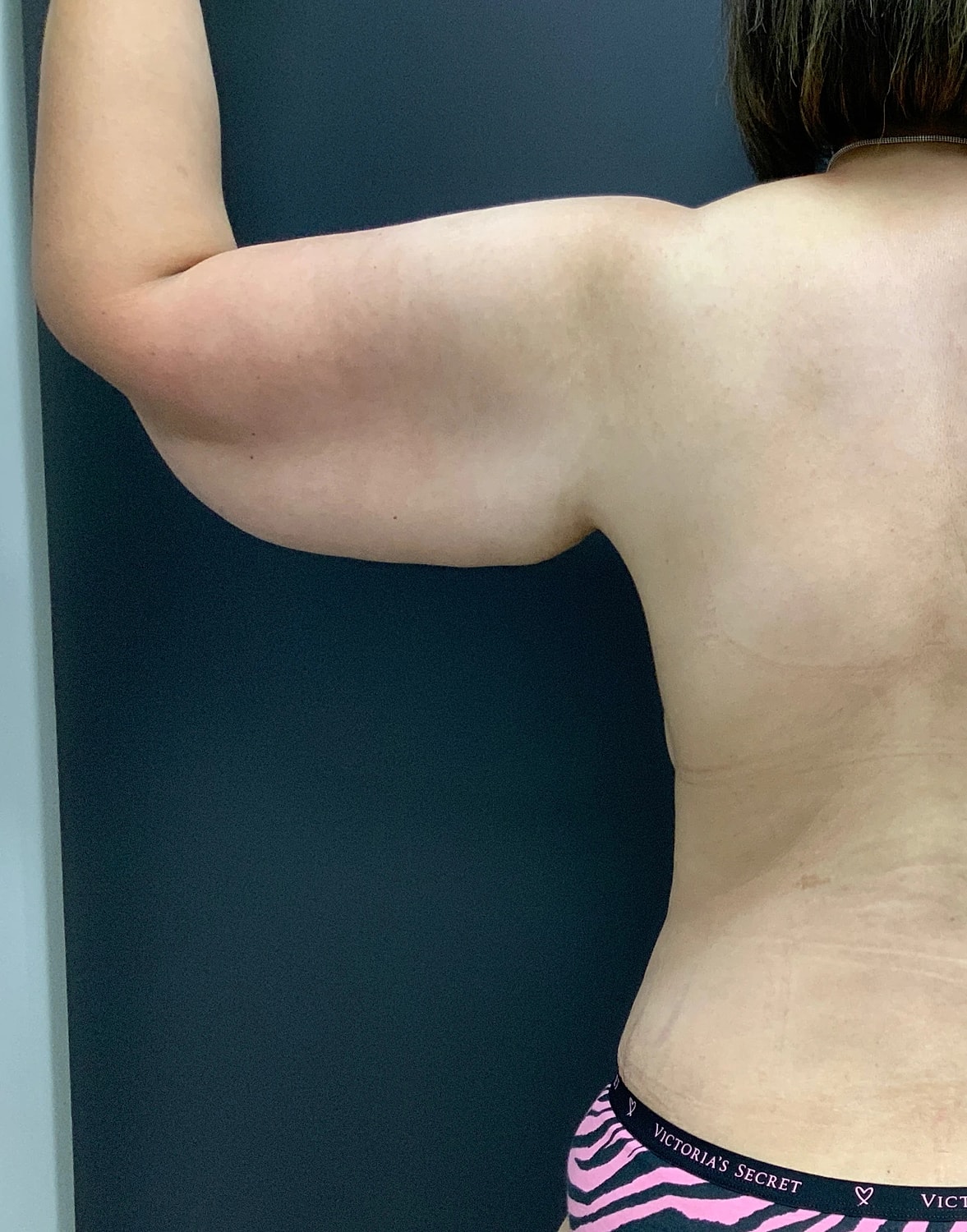 Arm Lift Thigh Lift Before & After