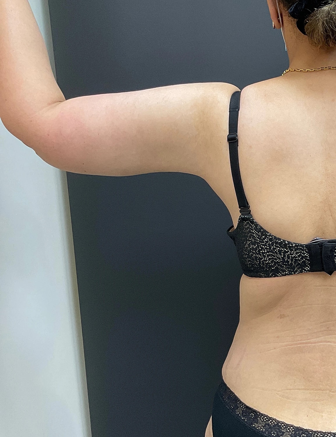 Arm Lift Thigh Lift Before & After