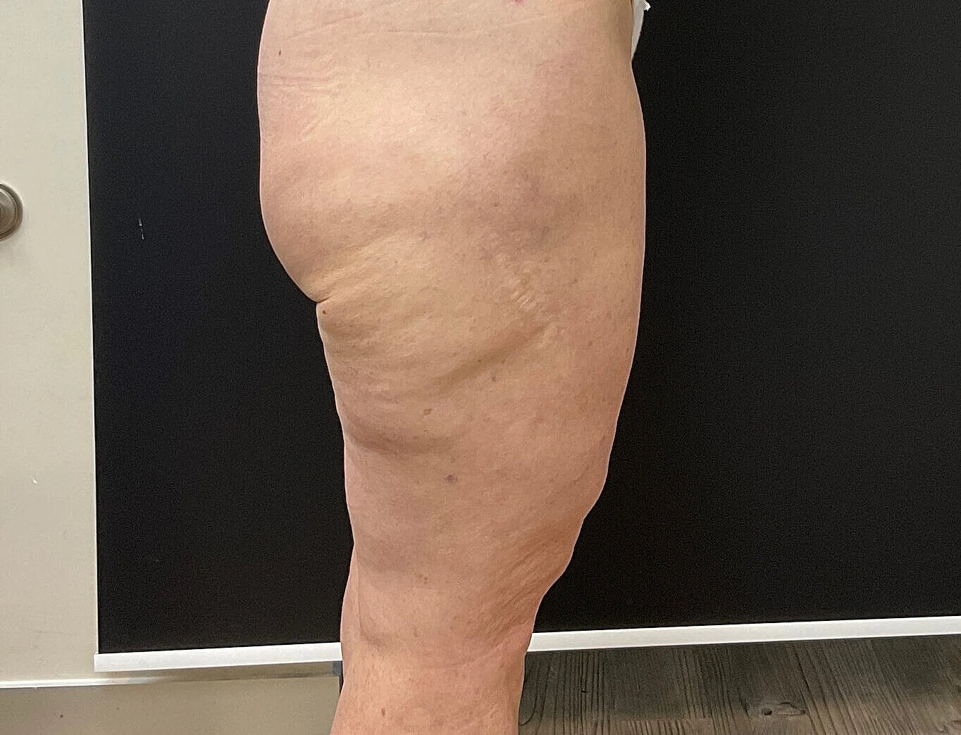 Close-up of a leg showing skin condition.