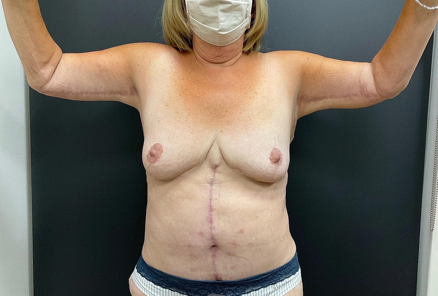 Arm Lift Thigh Lift Before & After