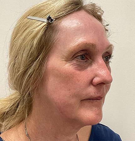 Phenol Peel Before & After