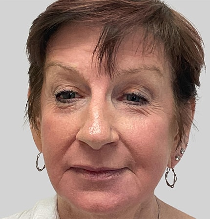 Phenol Peel Before & After