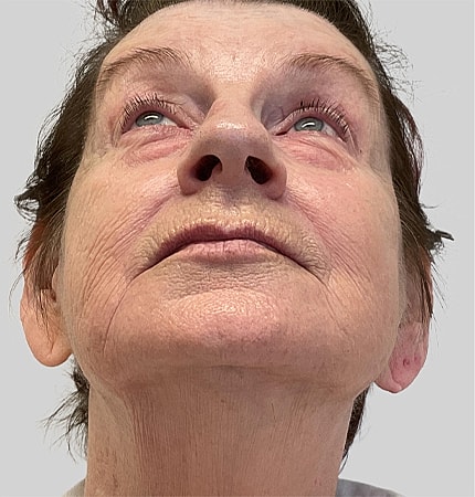 Phenol Peel Before & After