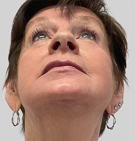 Phenol Peel Before & After