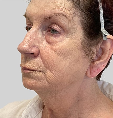 Phenol Peel Before & After
