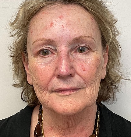 Phenol Peel Before & After