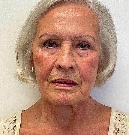 Phenol Peel Before & After