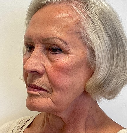 Phenol Peel Before & After