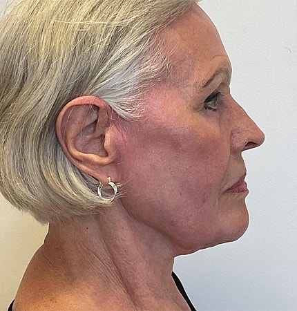 Phenol Peel Before & After