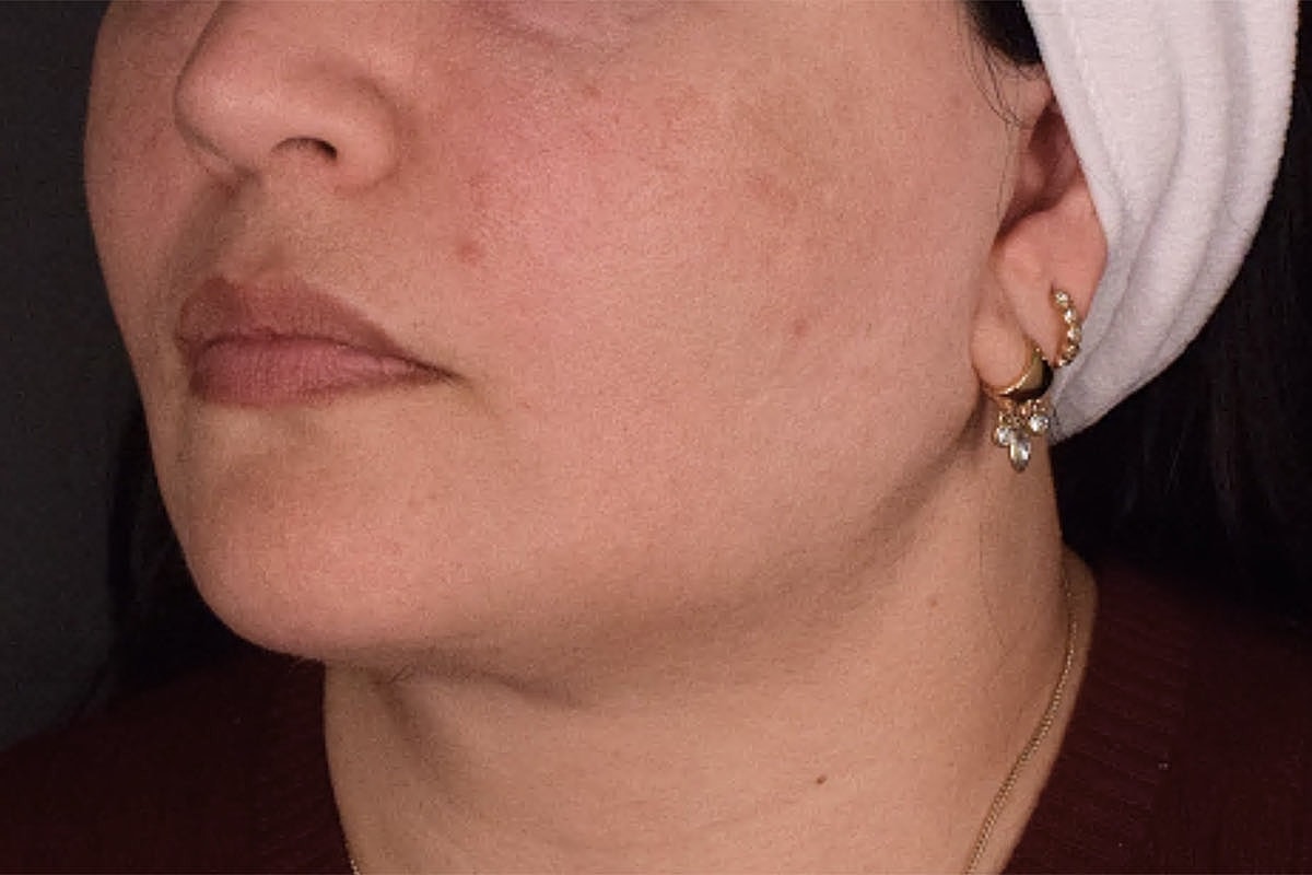 Facelift Neck Lift Before & After