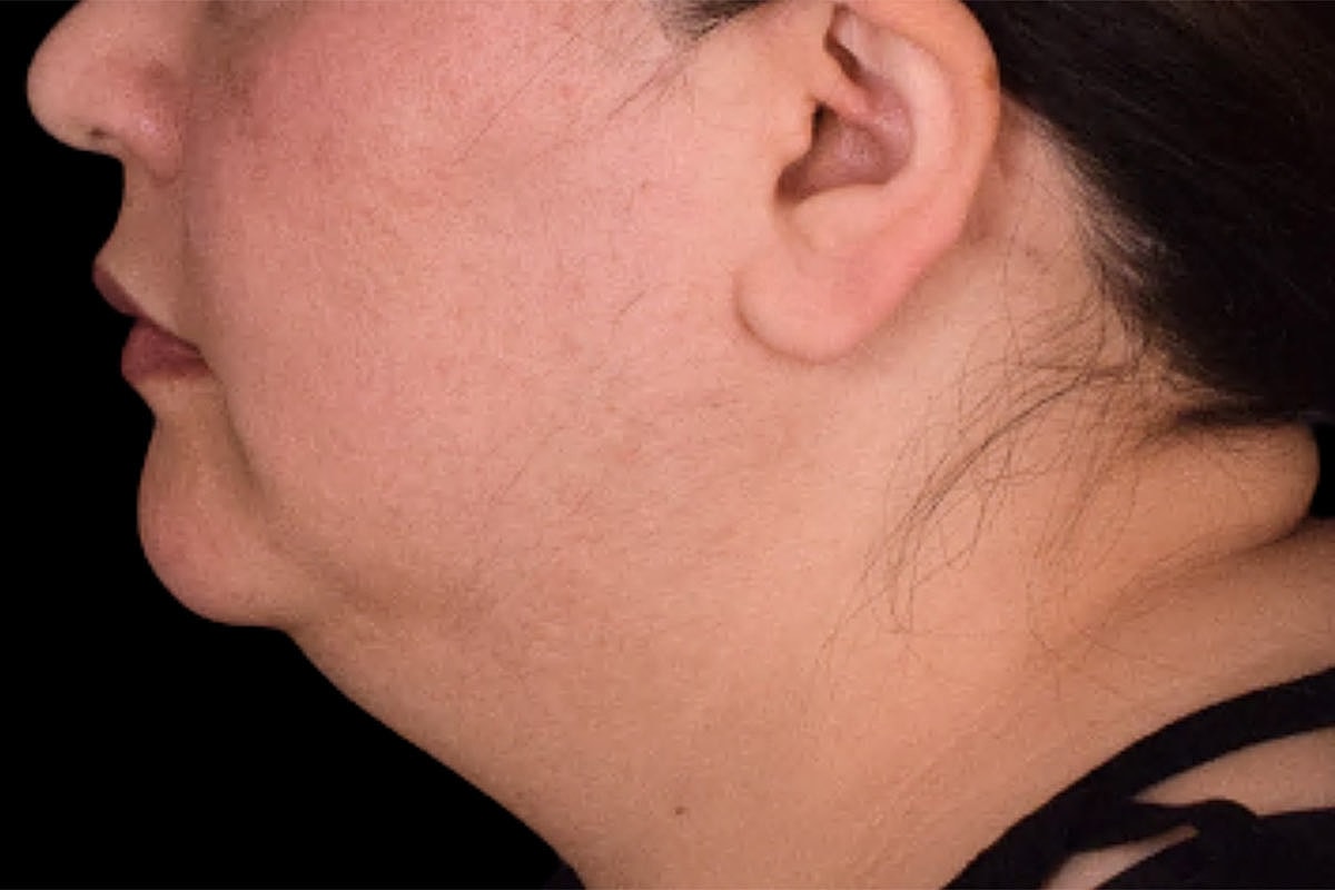 Facelift Neck Lift Before & After
