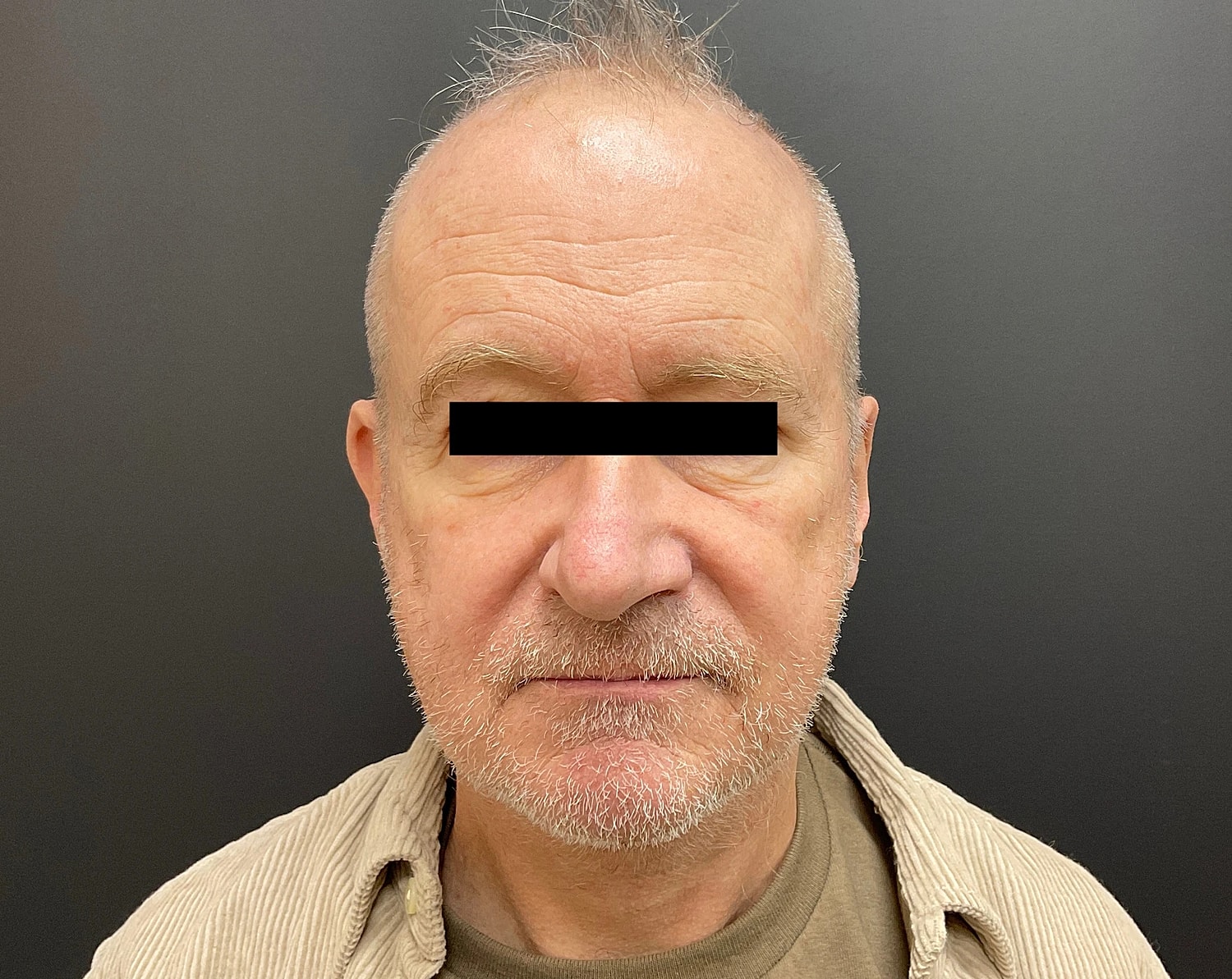 Facelift Neck Lift Before & After