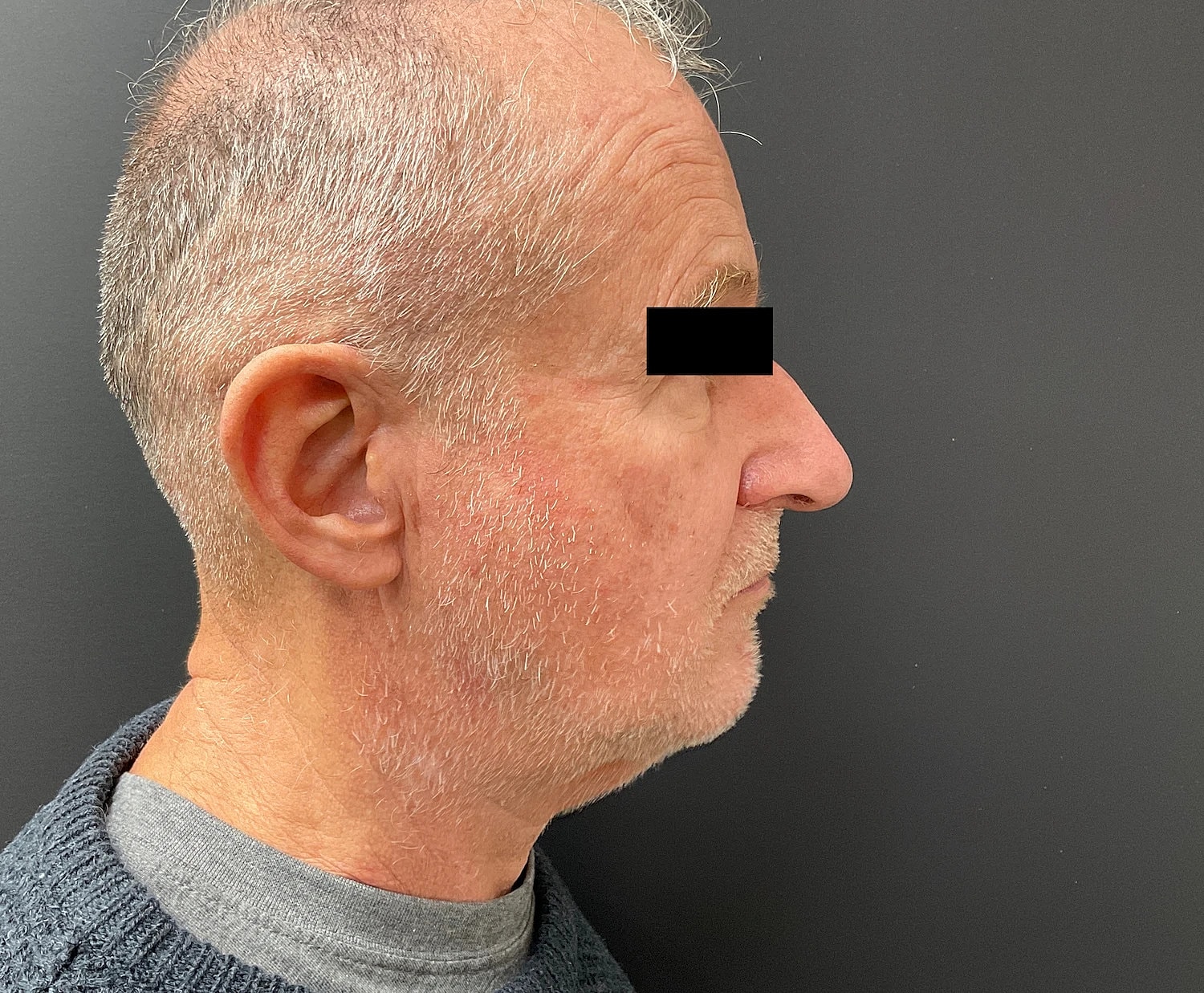 Facelift Neck Lift Before & After