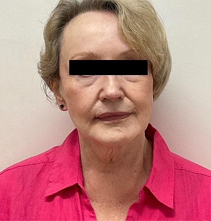 Facelift Neck Lift Before & After