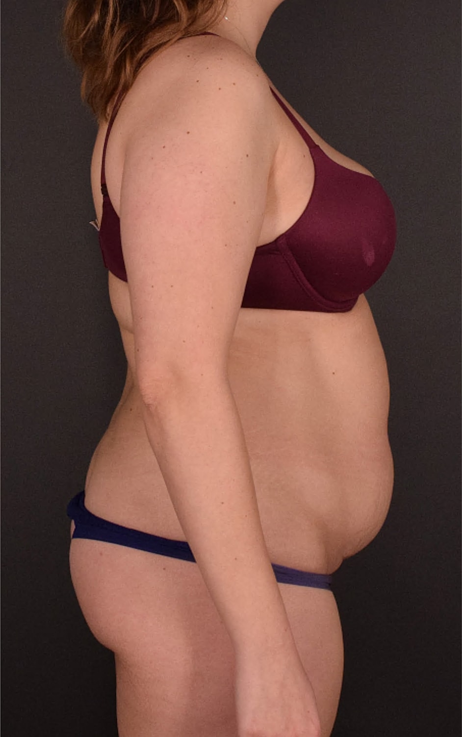Liposuction Before & After