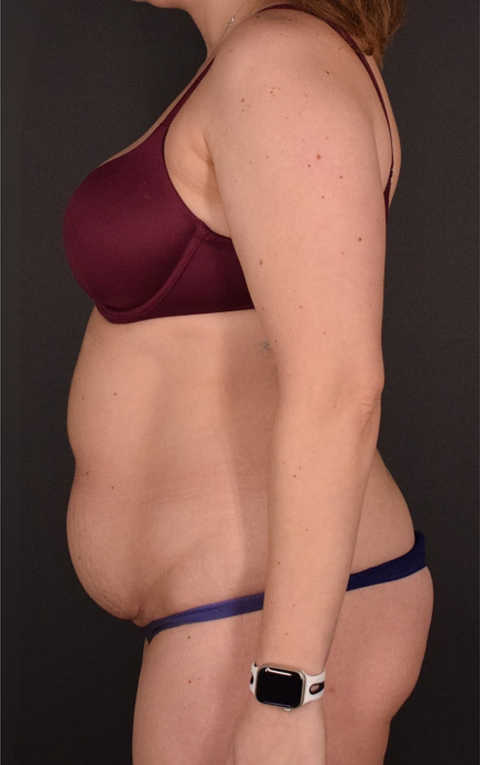 Liposuction Before & After
