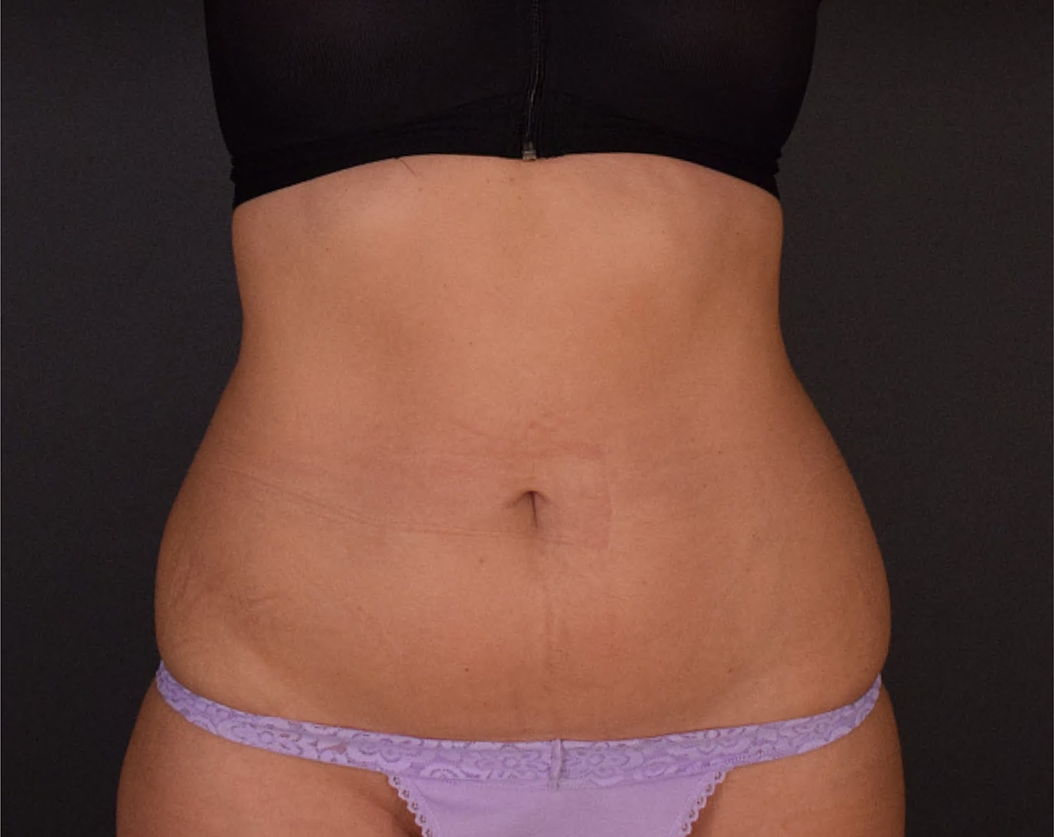Liposuction Before & After
