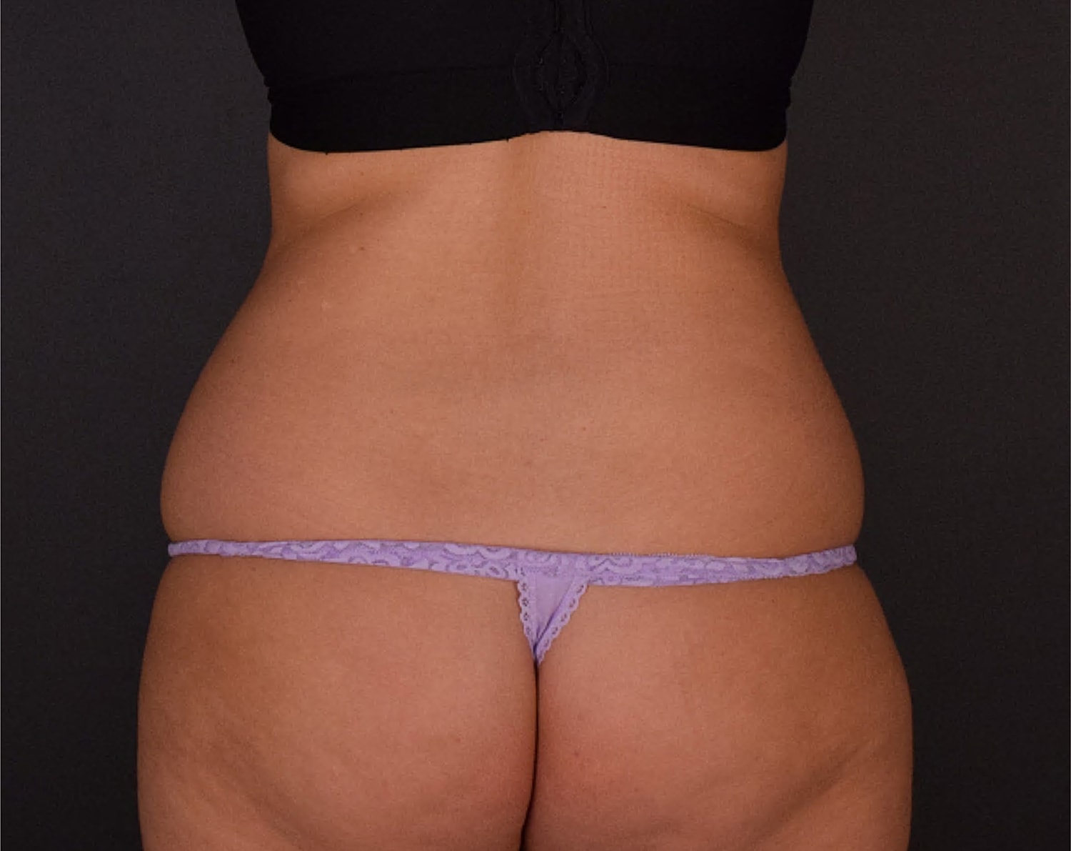 Liposuction Before & After