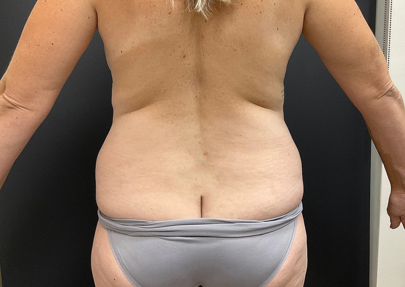 Liposuction Before & After