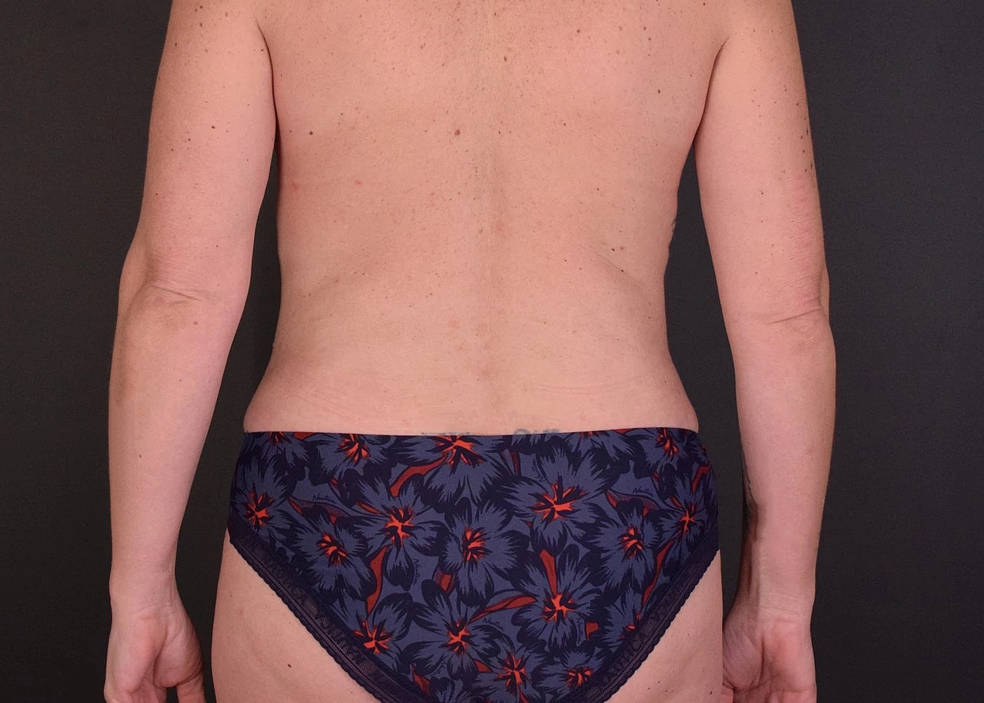 Liposuction Before & After