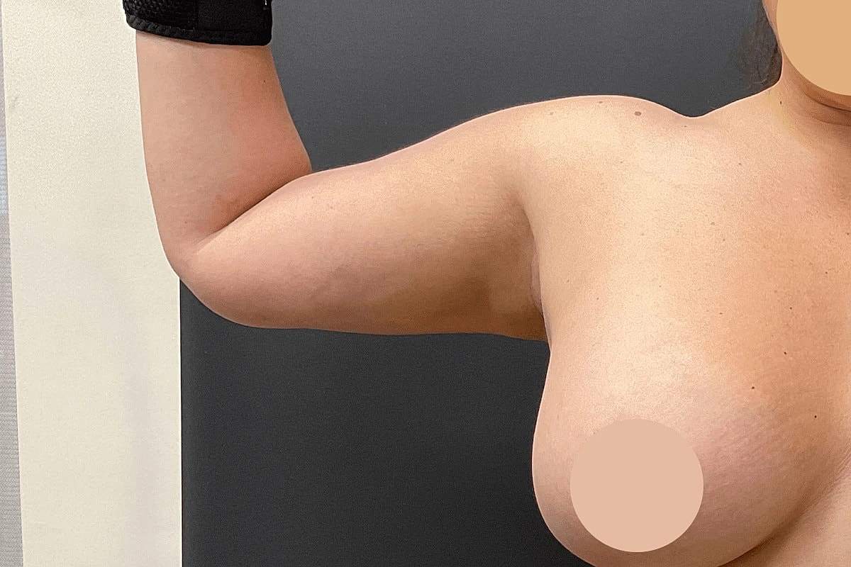 Liposuction Before & After