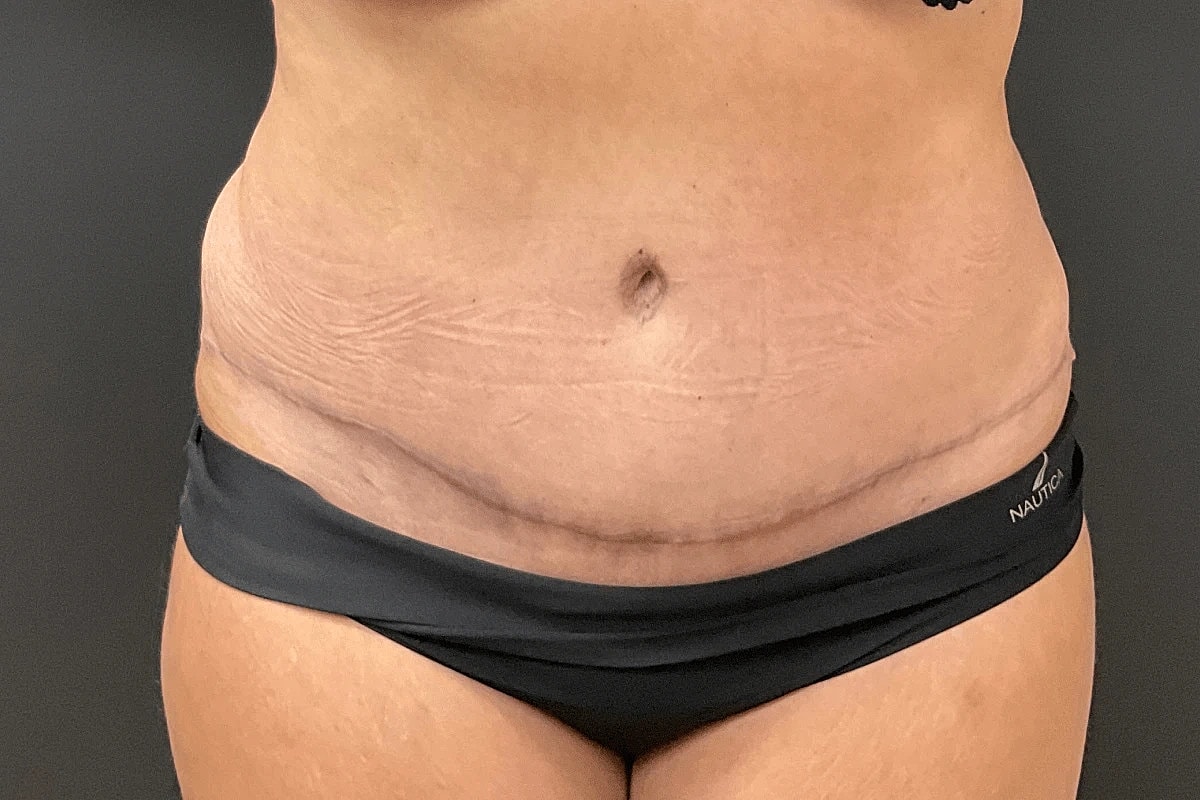 Liposuction Before & After