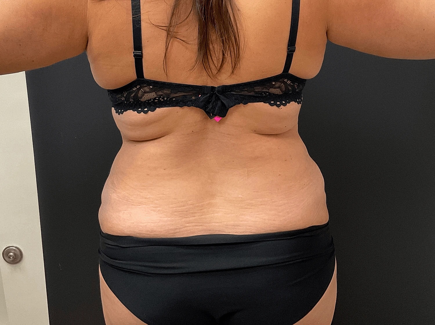 Liposuction Before & After