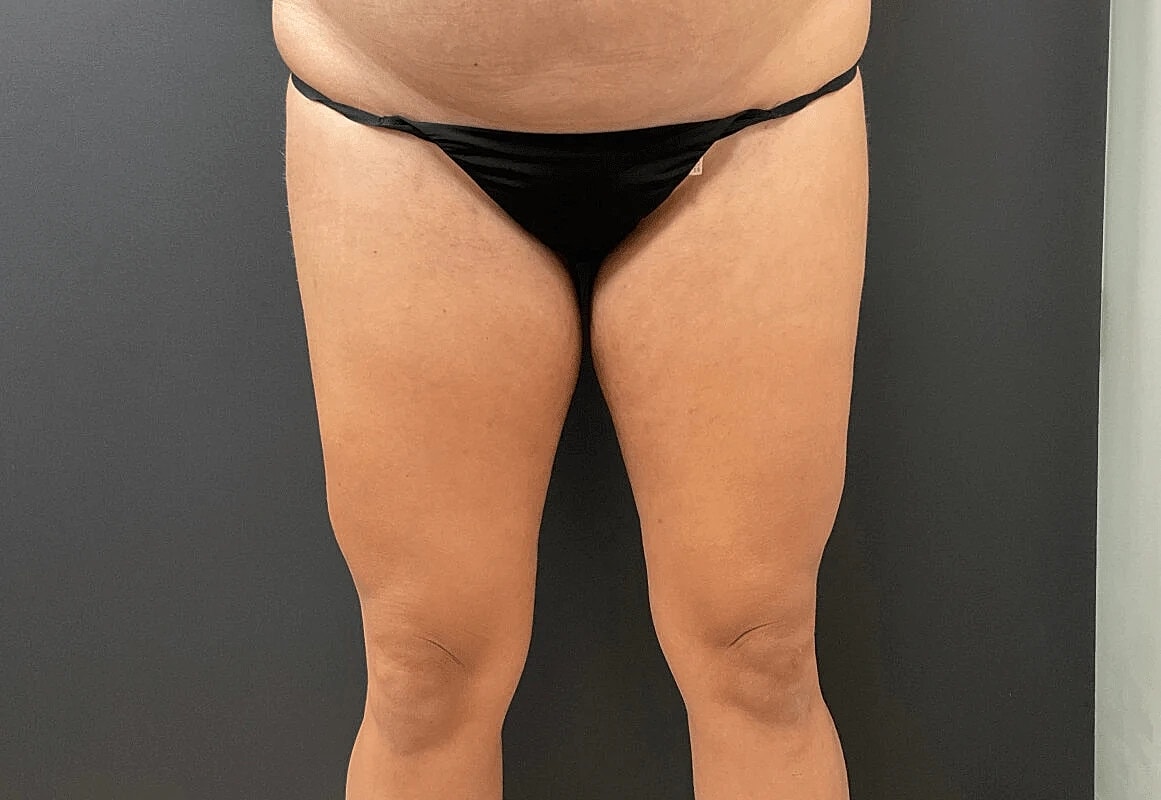 Liposuction Before & After