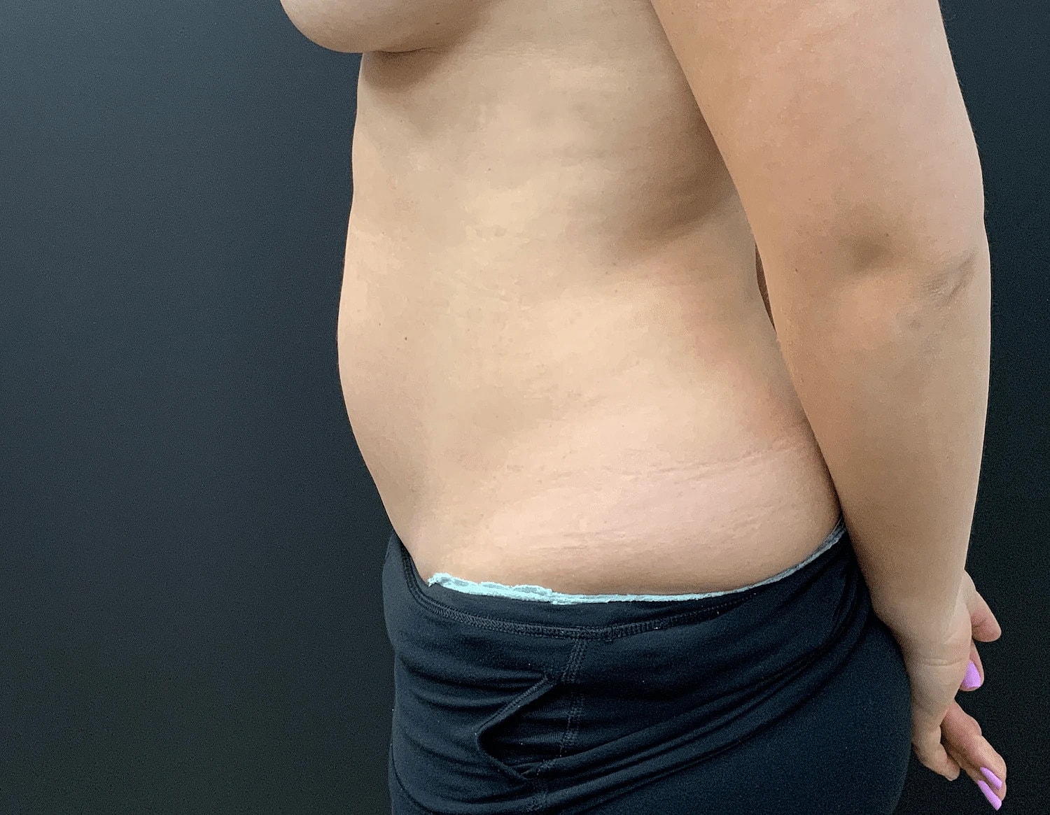 Liposuction Before & After