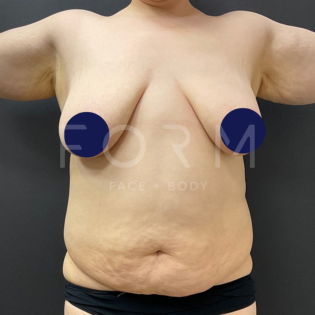Post Weight Loss Before & After