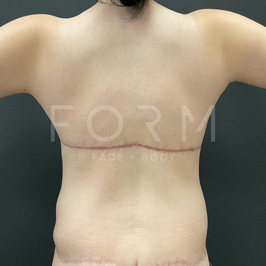 Post Weight Loss Before & After