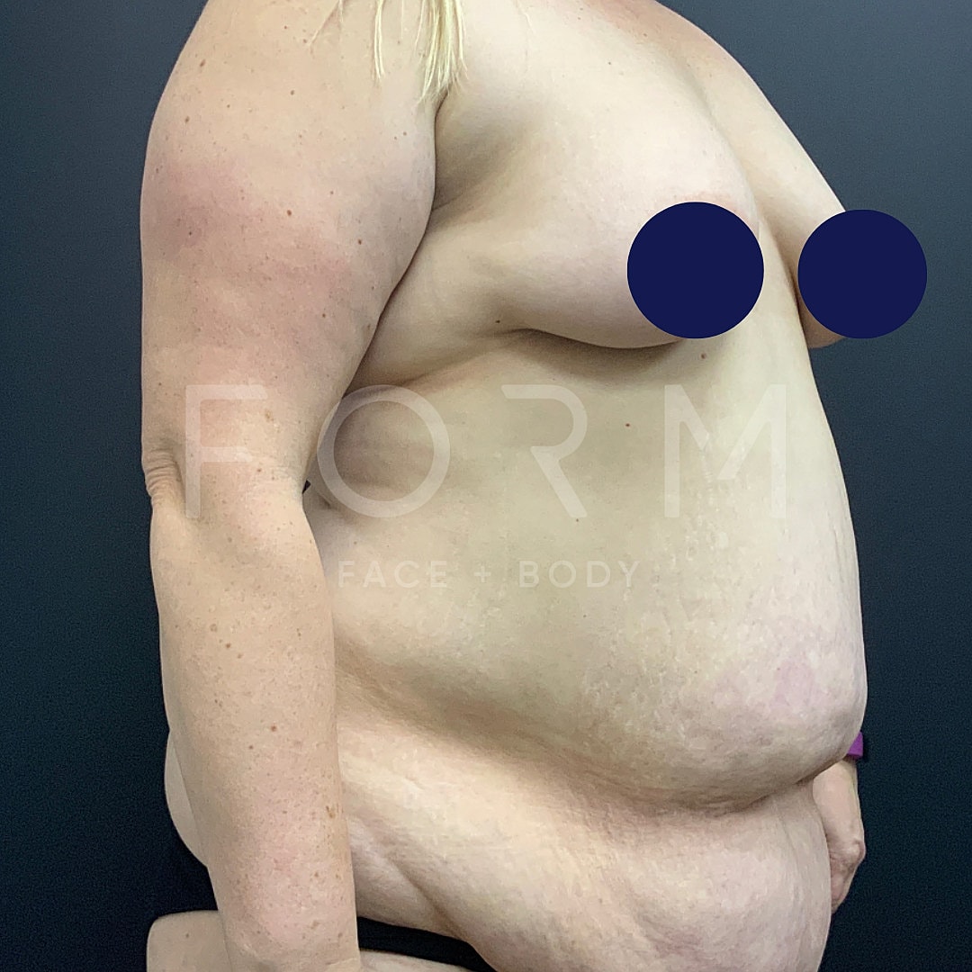 Post Weight Loss Before & After