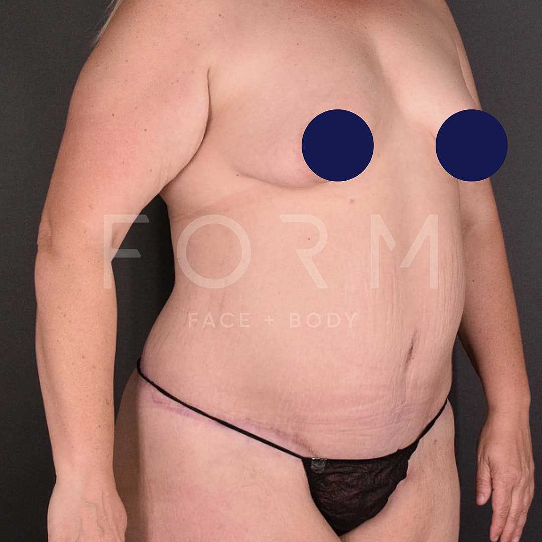 Post Weight Loss Before & After
