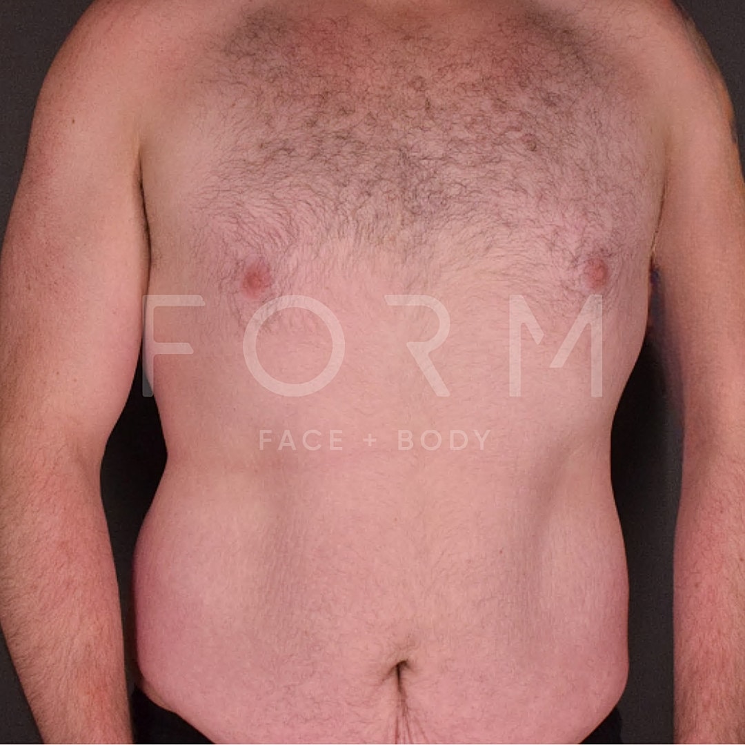 Post Weight Loss Before & After