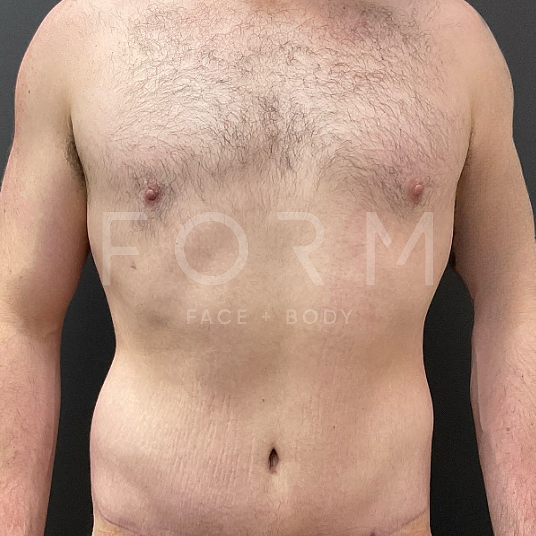 Post Weight Loss Before & After