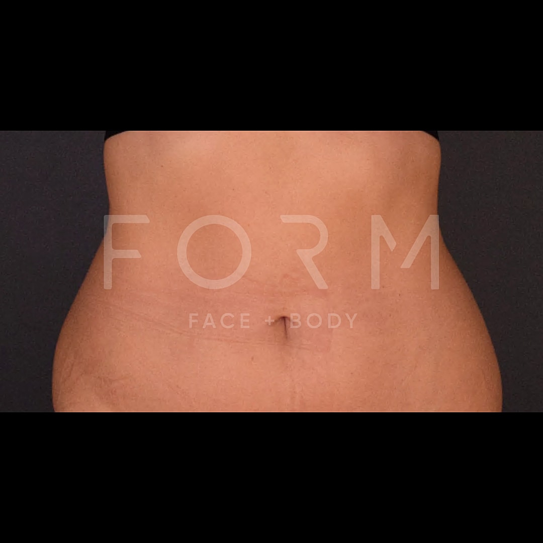 Post Weight Loss Before & After