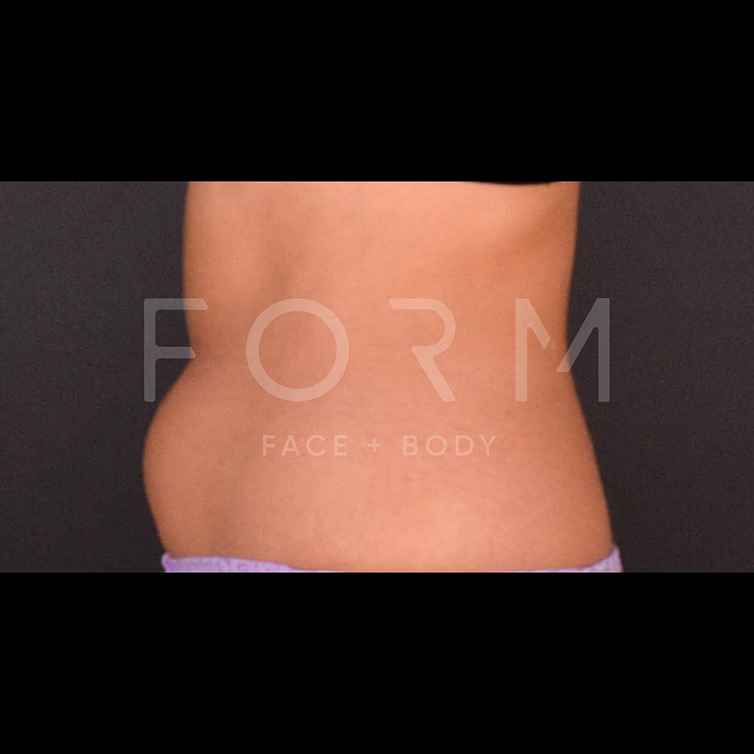 Post Weight Loss Before & After