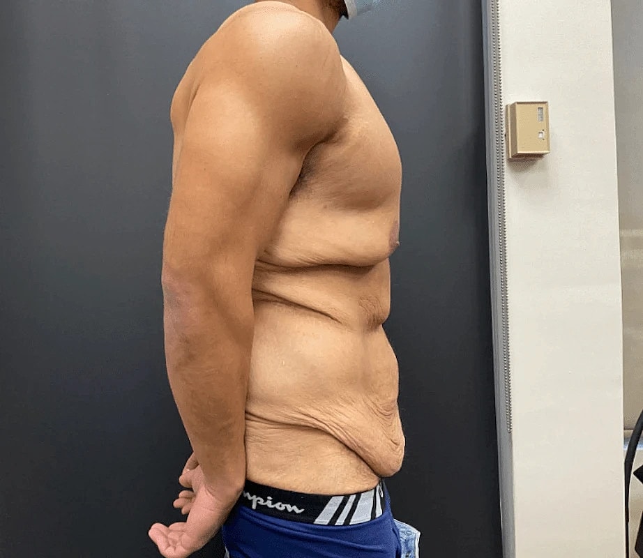 Post Weight Loss Before & After