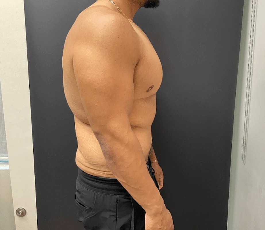 Post Weight Loss Before & After