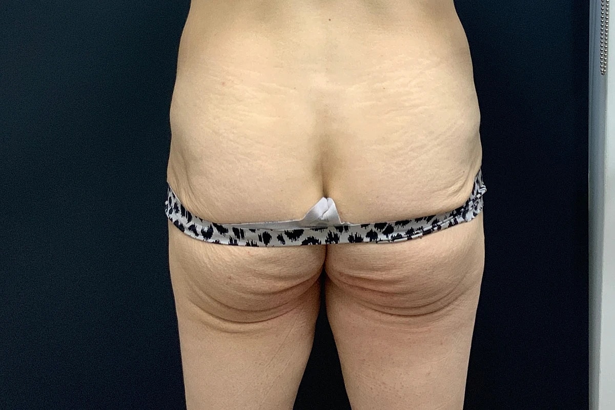 Post Weight Loss Before & After