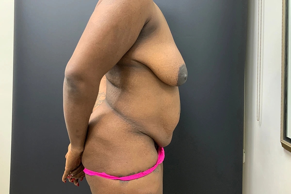Post Weight Loss Before & After