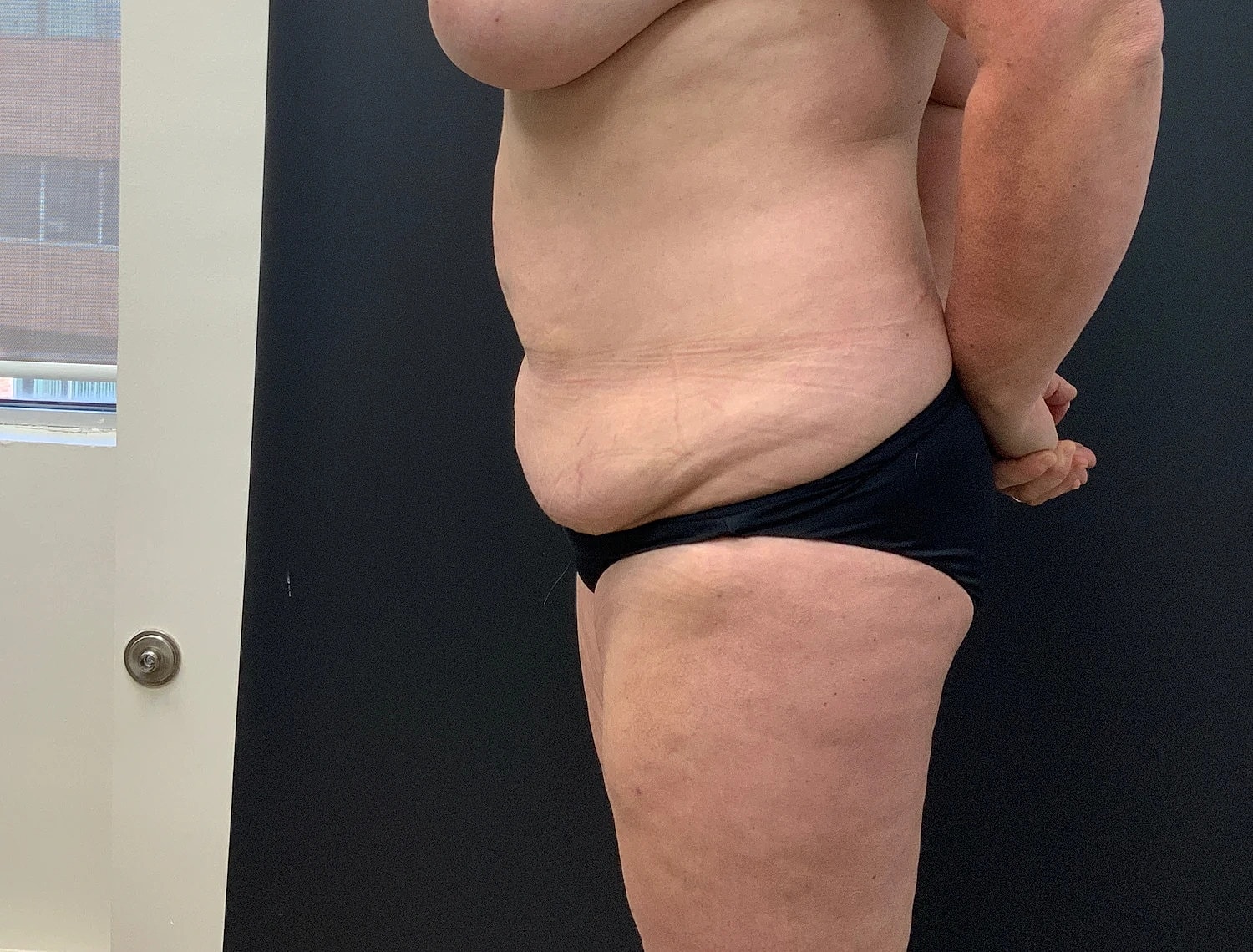 Post Weight Loss Before & After