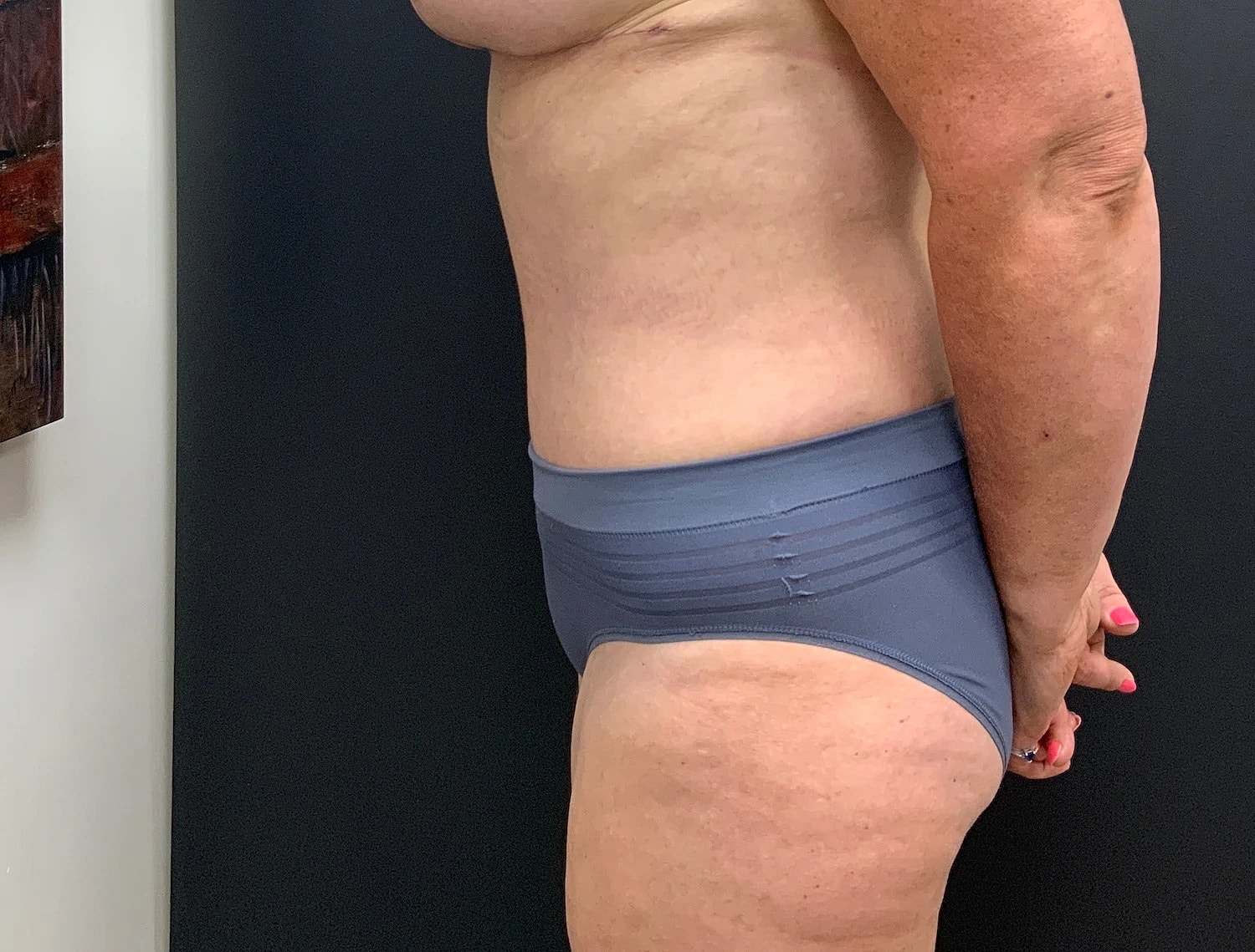 Post Weight Loss Before & After