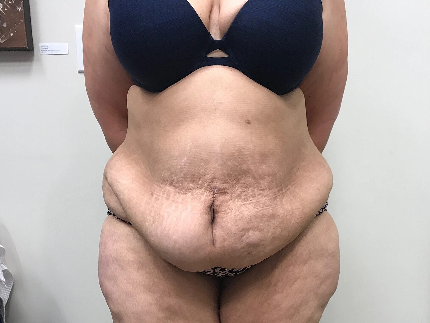 Post Weight Loss Before & After