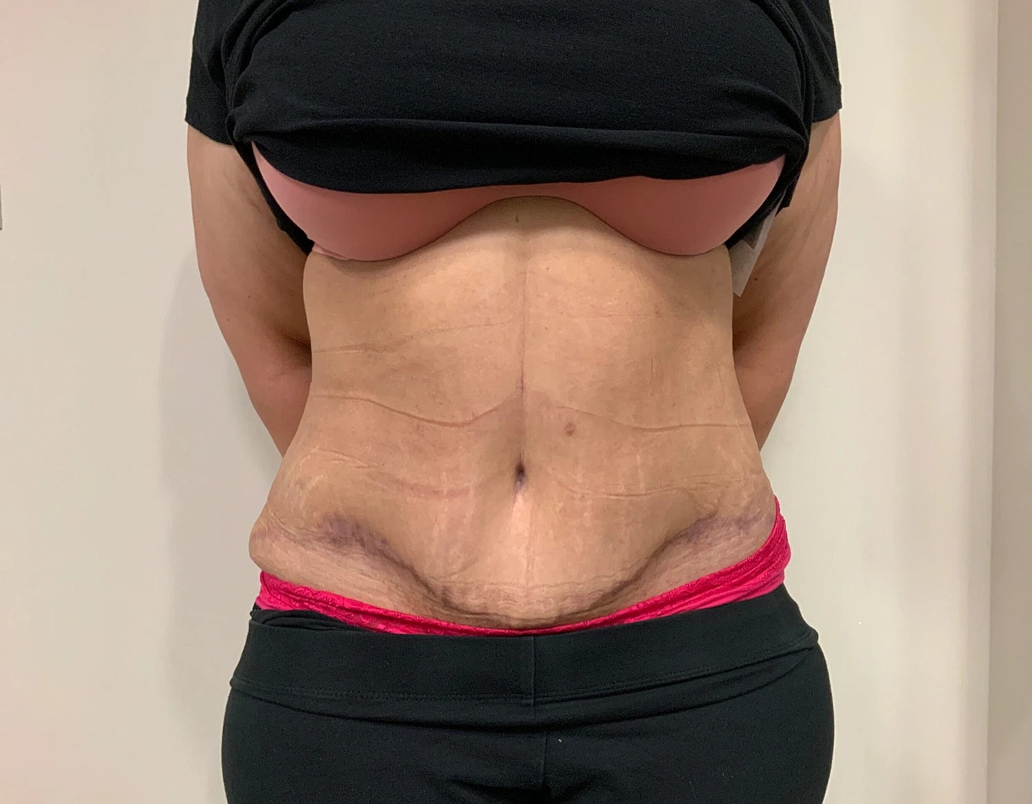 Post Weight Loss Before & After