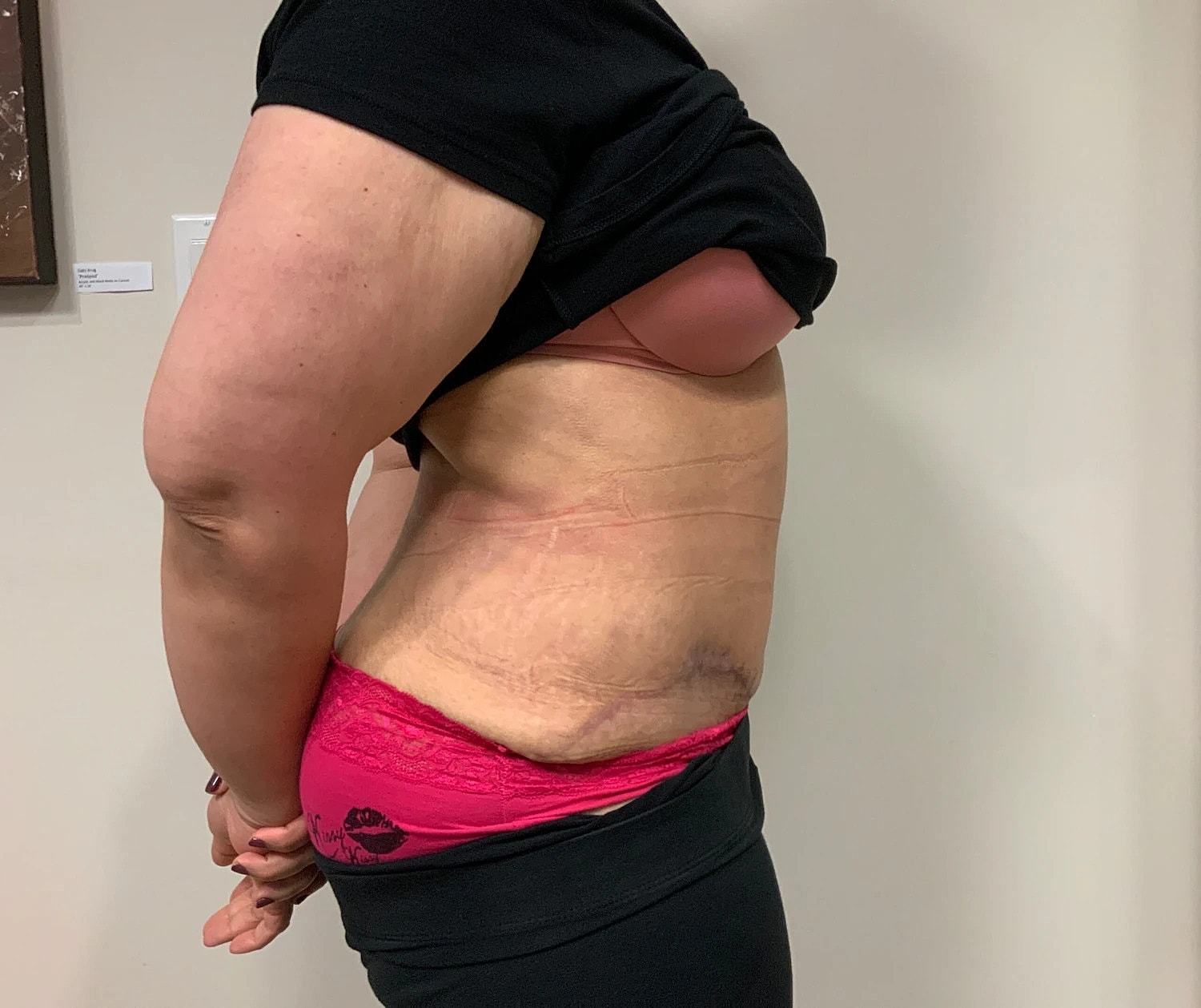 Post Weight Loss Before & After