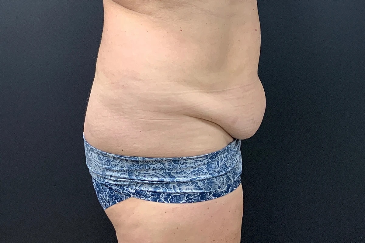Post Weight Loss Before & After
