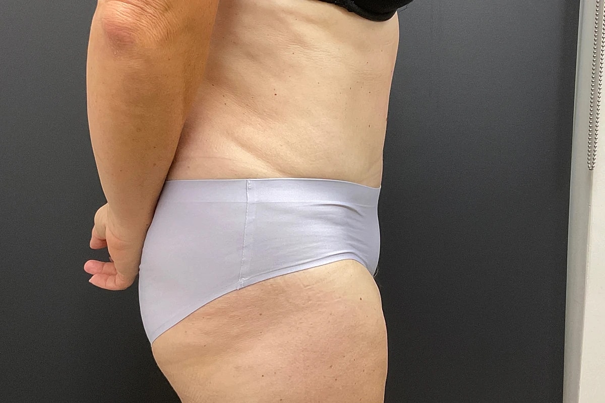 Post Weight Loss Before & After