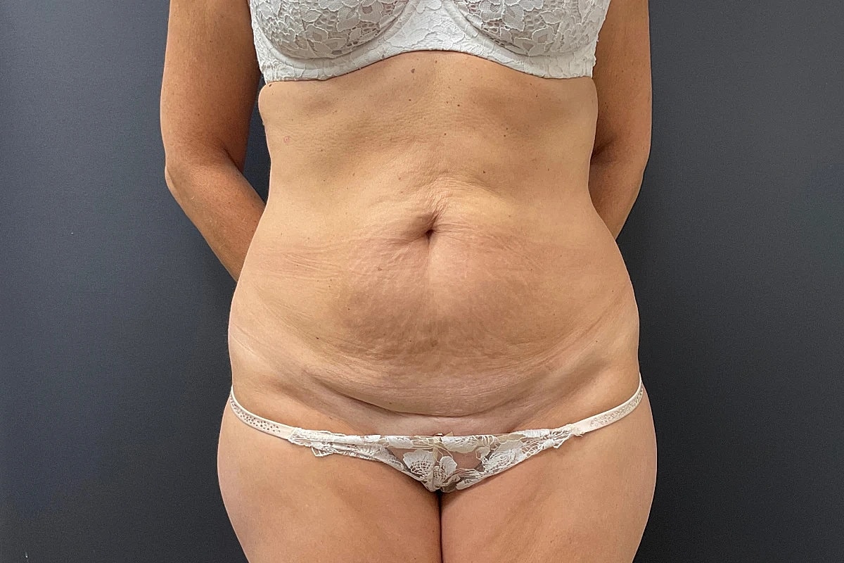 Post Weight Loss Before & After
