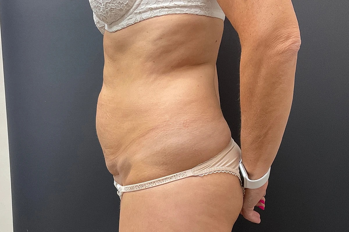 Post Weight Loss Before & After